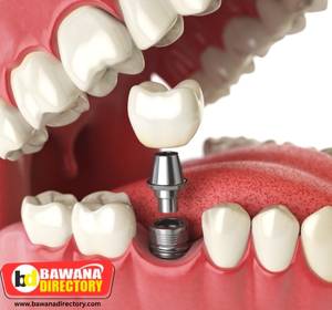 Dental implants